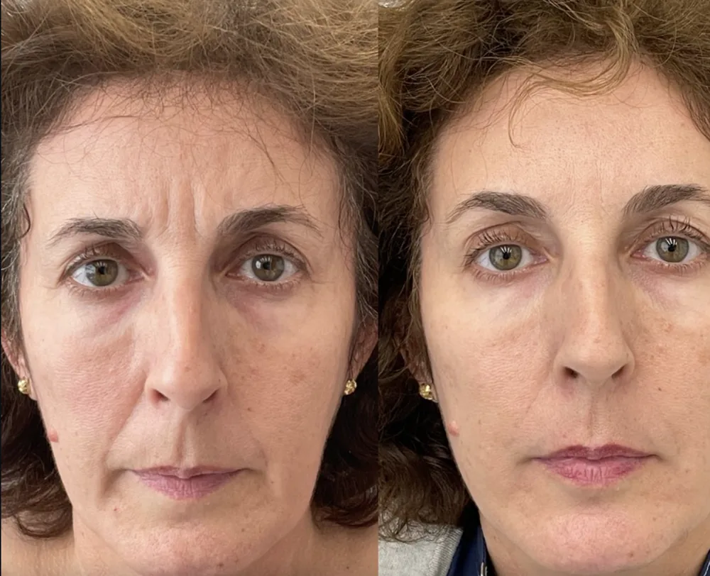 Antes e depois de preenchimento de bigode chinês e toxina botulínica
