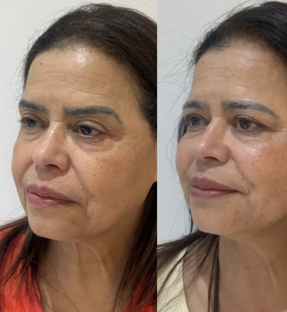 Antes e depois de bioestimulador de colágeno