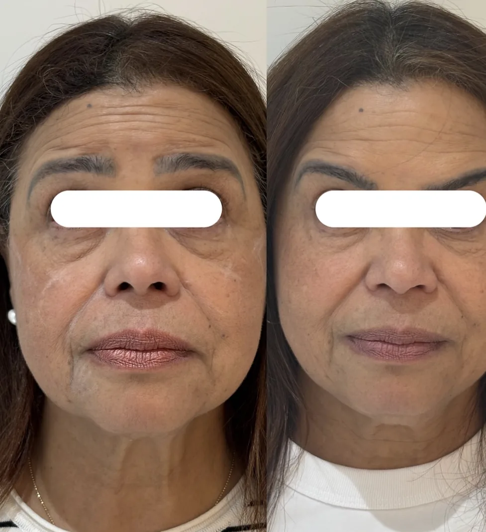 Antes e depois: Terço médio e mandíbula
