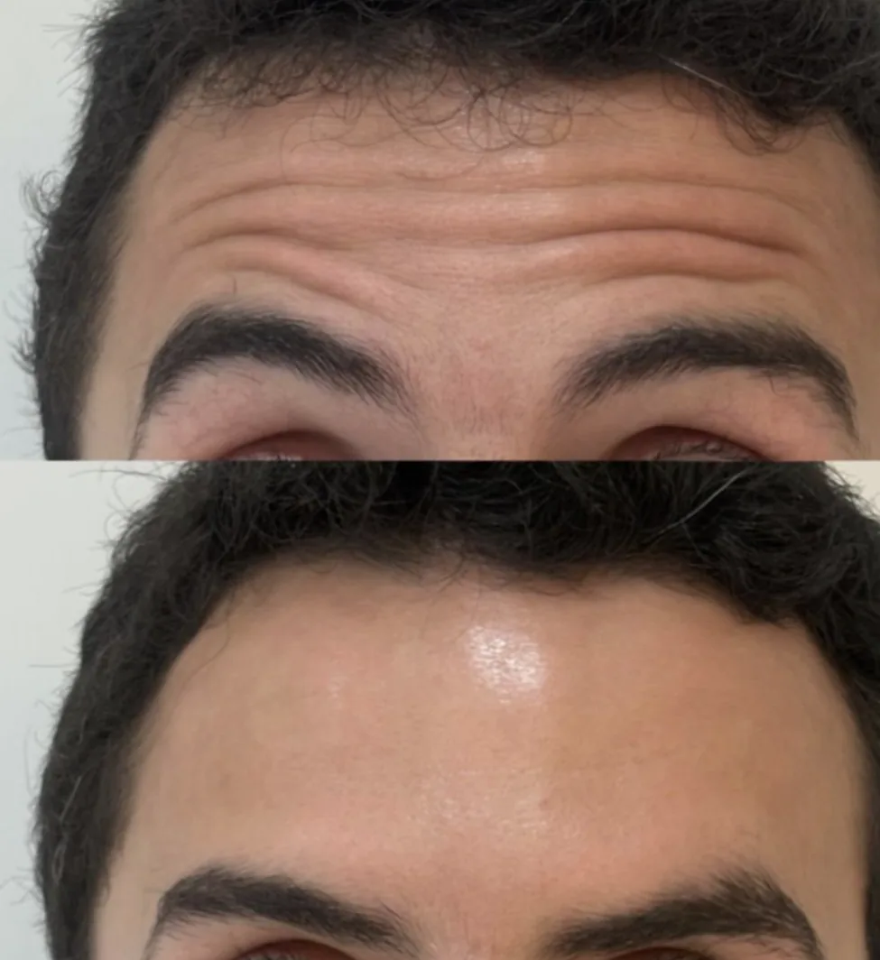 Antes e depois de toxina botulínica na testa