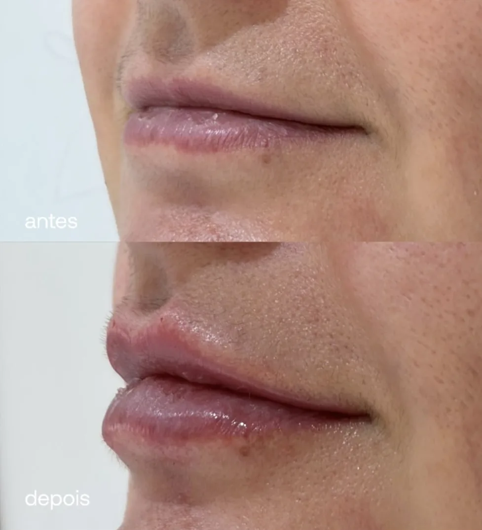 Antes e depois: Contorno e volume