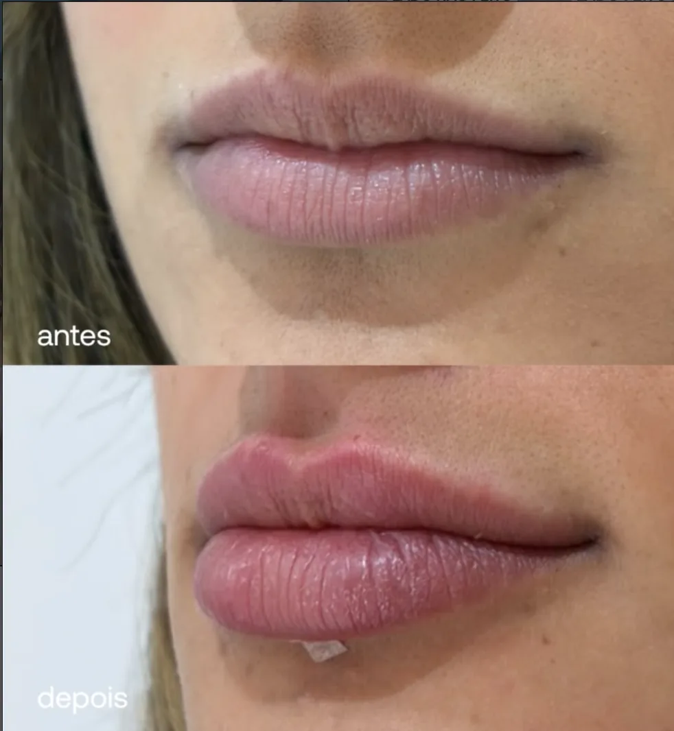 Antes e depois de preenchimento labial