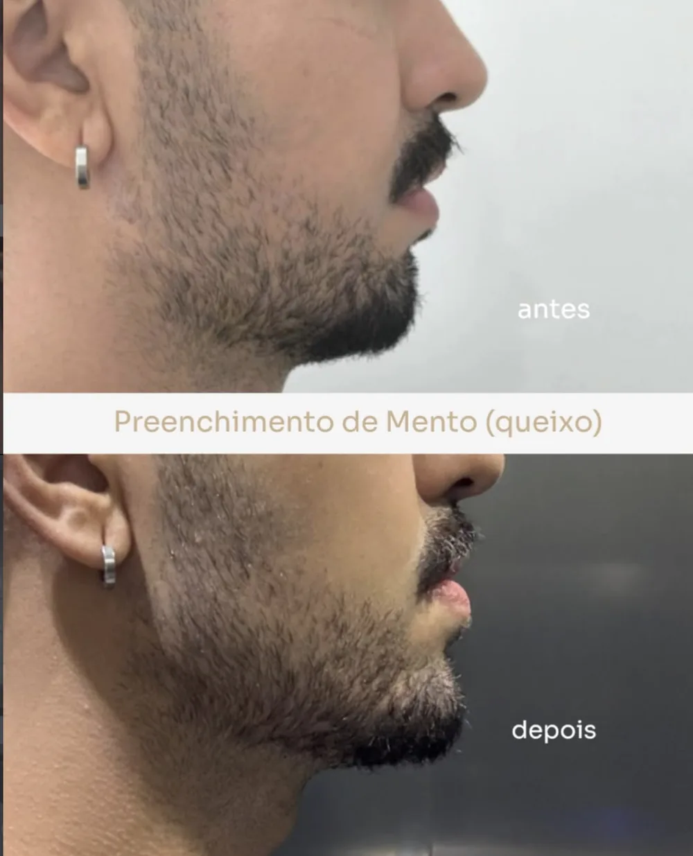 Antes e depois de preenchimento de mento