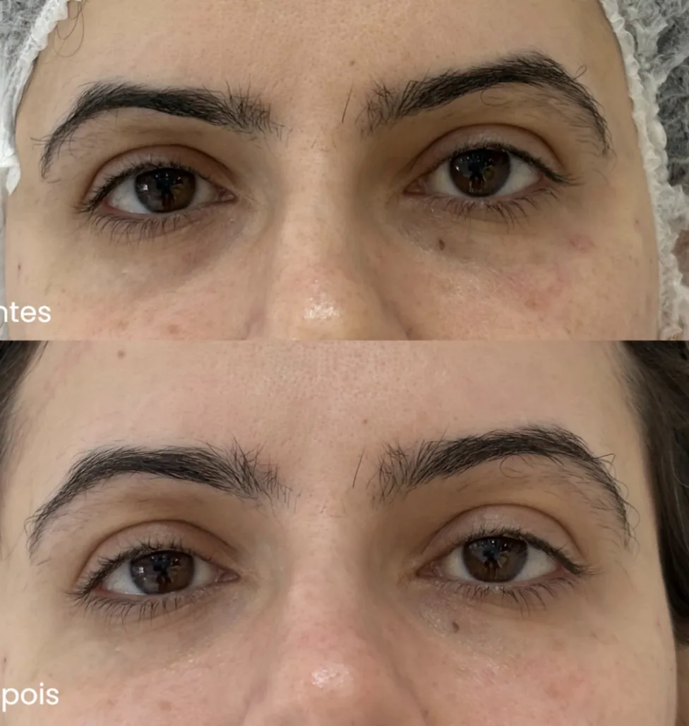 Antes e depois de preenchimento de olheiras