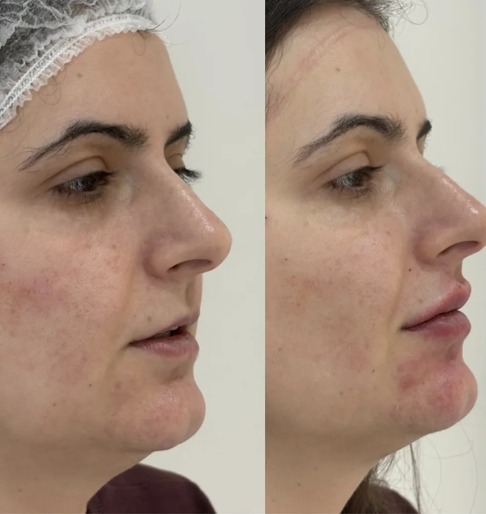 Antes e depois: Projeção labial de perfil