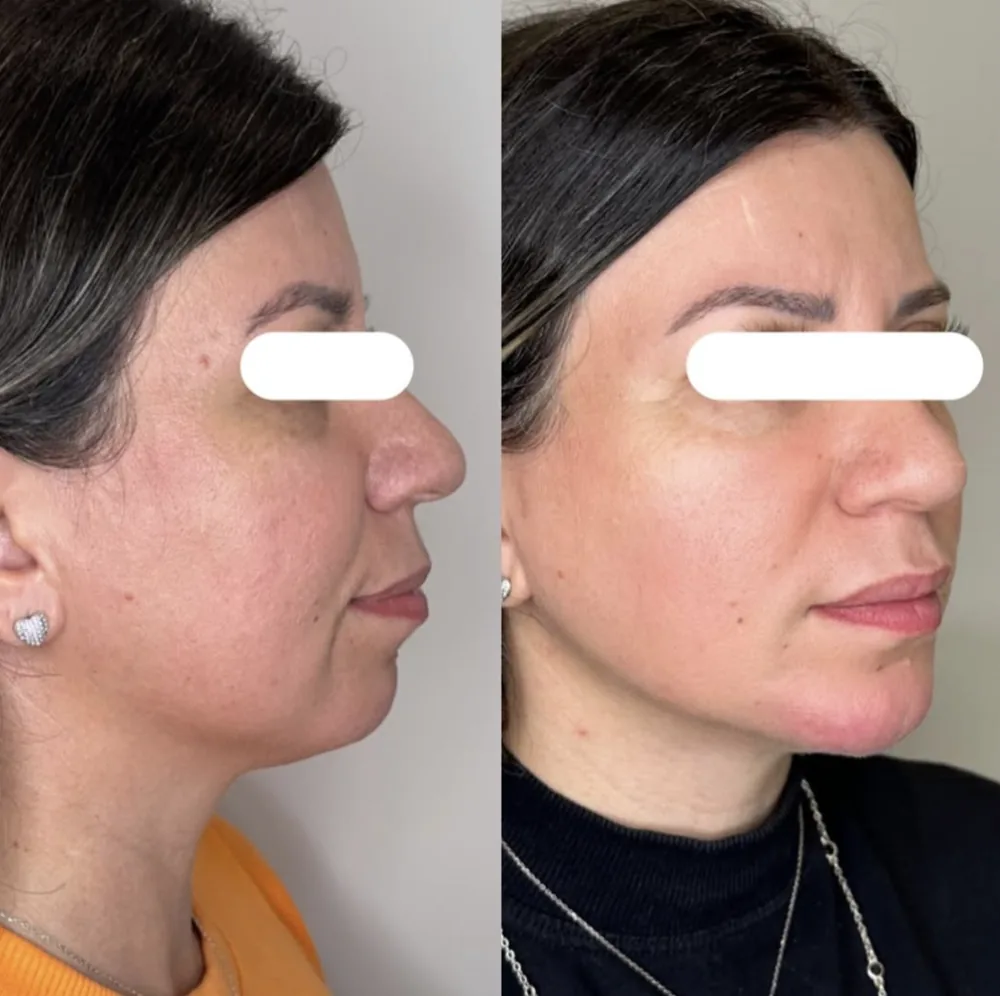 Antes e depois: Contorno mandibular